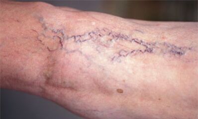 a lábak visszér kezelésének módszerei