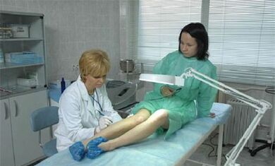 hogyan kell kezelni a varikózist a lábakon