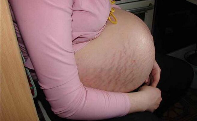 a varikózus vénák okai a terhesség alatt