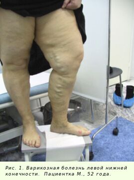 A varikózus vénákat kezelni kell a folyamat megállításához