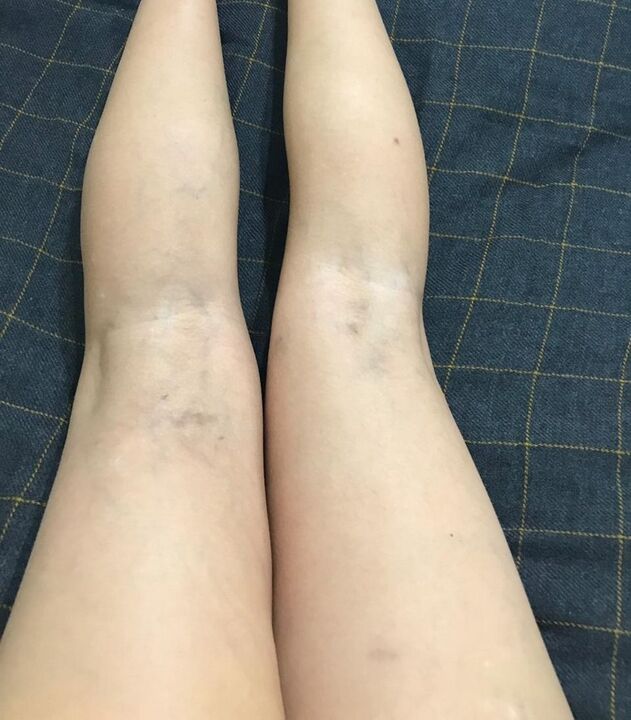 a visszerek megnyilvánulása a lábakon